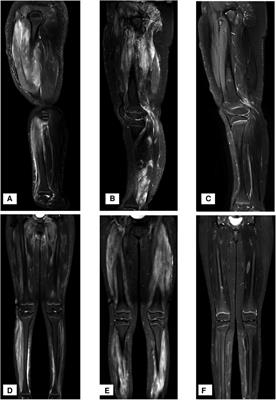 Juvenile dermatomyositis and nephrotic syndrome: A case report and a mini literature review